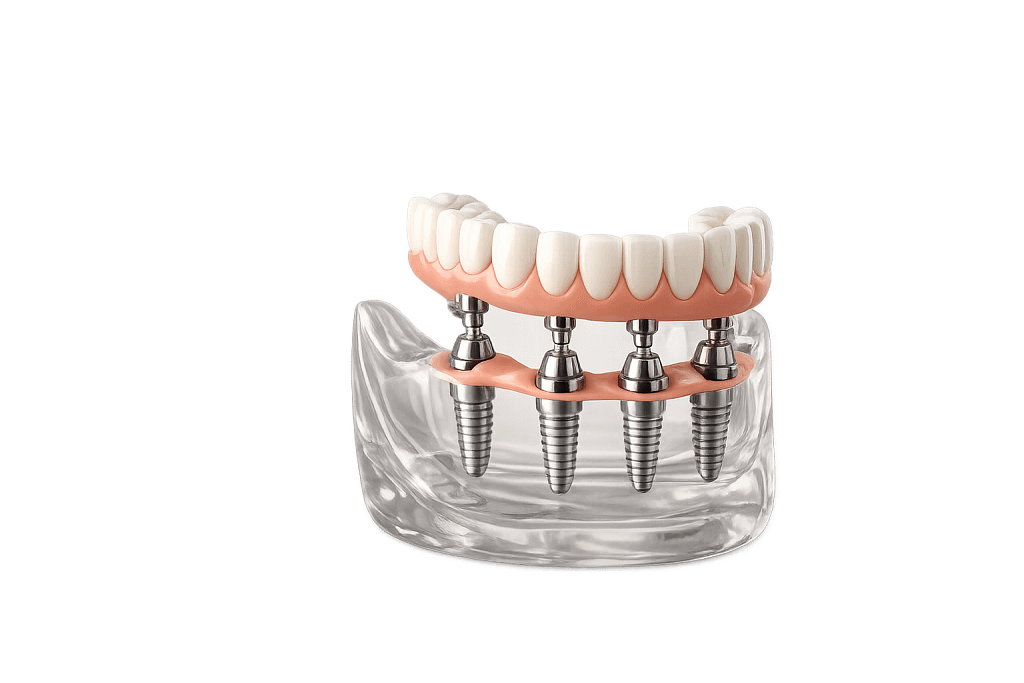 Odbudowa pełnołukowa na implantach – Poznań